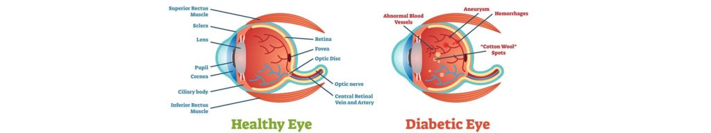 diabetic eye diseases img