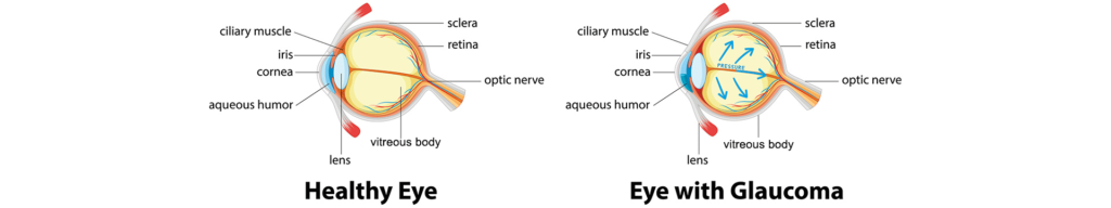eye glaucoma diagram 1